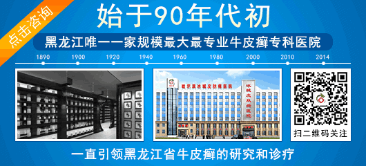 哈尔滨哪家看银屑病好