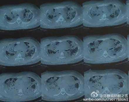 年轻妈妈的生命倒计时,急需寻找“续命”肺源