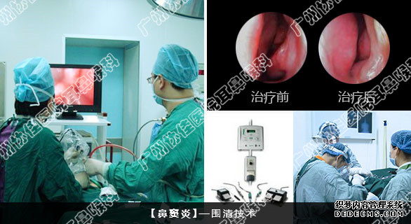 主任发现其鼻窦炎已经侵犯了多个鼻窦,但所幸并没有引起其他的并发症