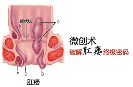 脓肿2.jpg