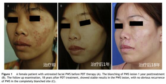 中国海姆泊芬光动力治疗鲜红斑痣疗法亮相巴黎